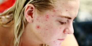 cbd ir spuogai akne cbd ir spuogai akne